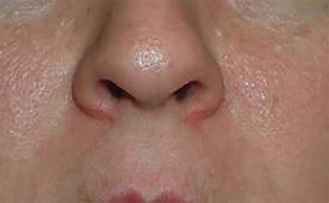 Skin Colored Papules On The Cheeks Acrochordons On The Axillae