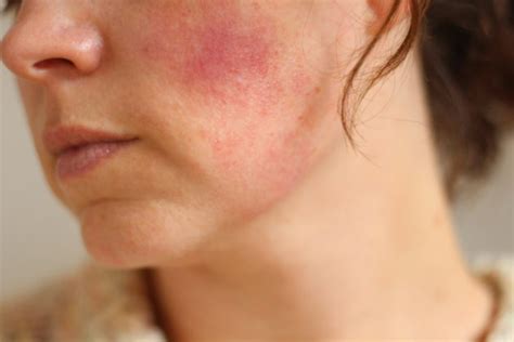 Red Blotches On Face Treatment Pictures Causes Of Red Spots On Face