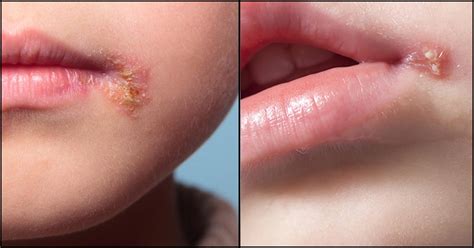 Cold Sores In Babies Causes Risk Treatment And Prevention