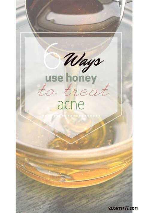 6 Ways To Use Honey To Treat Acne In 2020 How To Treat Acne Skin
