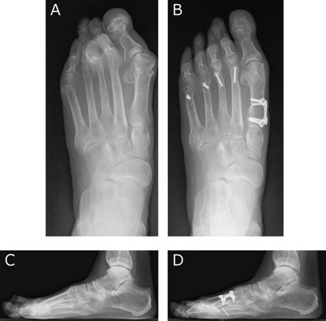 Subjective And Objective Outcomes Of Surgery For Rheumatoid Forefoot