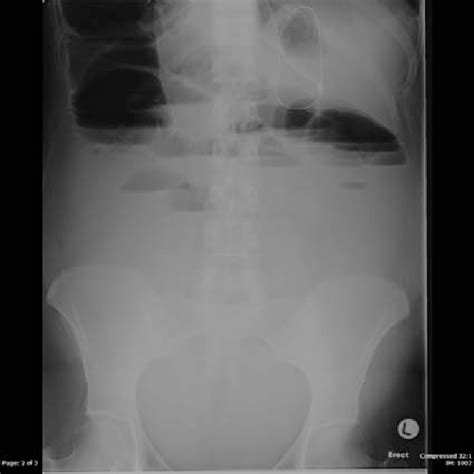 Erect Abdominal Radiograph Showing Multiple Air Fluid Levels
