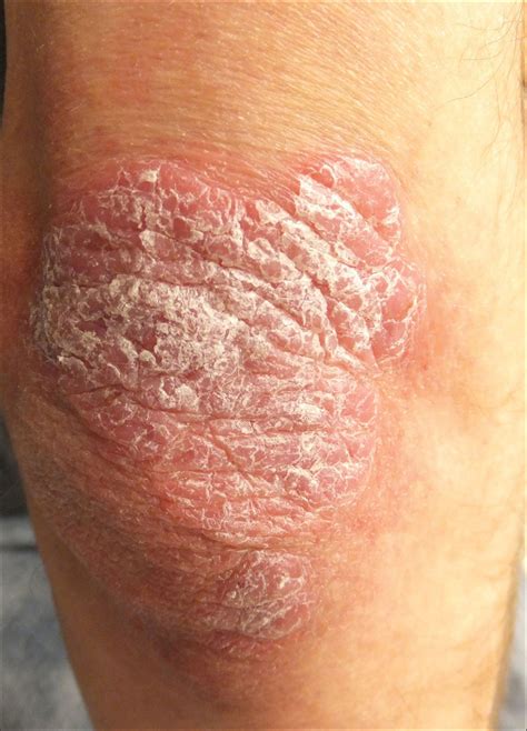 Thick Scaly Plaques On The Wrists Knees And Feet Mdedge Dermatology