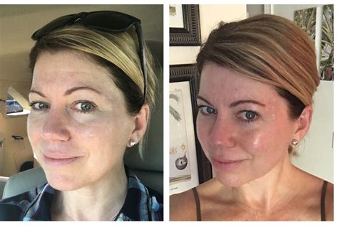Dermaplaning Before And After Pictures Change Comin
