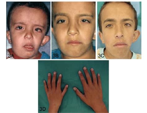A Frontal Photograph Of The Patient With Goldenhar Syndrome Before Download Scientific Diagram