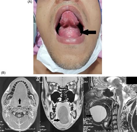 Swelling Of The Floor Of The Mouth The American Journal Of Medicine