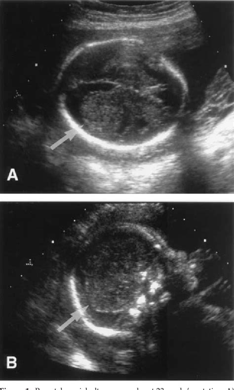 Figure 1 From Prenatal Sonographic Findings Associated With Sporadic