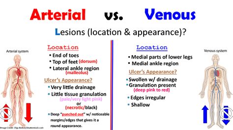 Peripheral Arterial Disease Vs Peripheral Venous Disease Nclex Review
