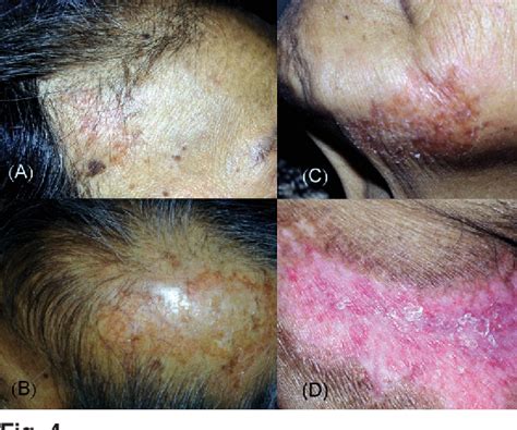 Figure 4 From Disseminated Lupus Vulgaris With Clinical Manifestations