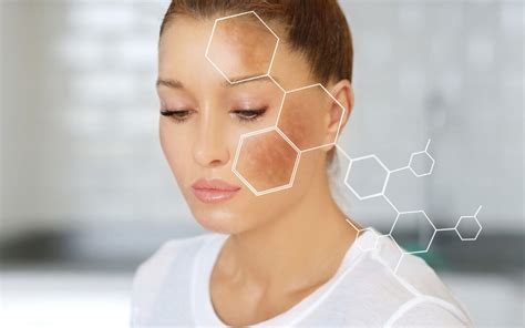 Melasma Causes Treatments And Prevention Integrated Dermatology Of