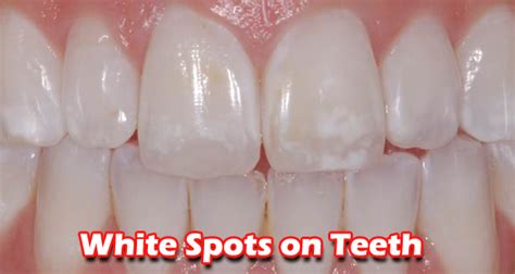 How To Get Rid Of White Spots On Teeth