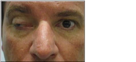 A partial 3rd nerve palsy is when one or more of the extraocular muscles innervated by the 3th nerve are not affected or when there is only paresis of the 11. Complete III Cranial Nerve Palsy in a Leather Worker: An ...