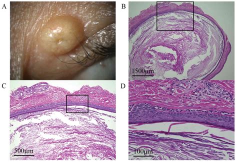 Clinicopathological Features Of Cystic Lesions In The Eyelid
