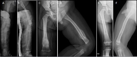 Femoral Shaft Fractures In Pediatric Age Treatment Strategies And Results