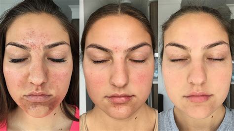 My Accutane Experience How I Got Clear Skin Before After Pictures
