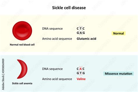 Sickle Cell Disease Comparison Of Dna Sequence Between Normal Red