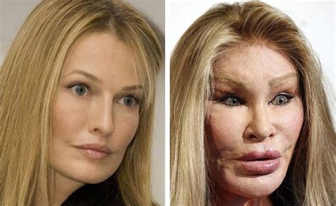 Jocelyn Wildenstein Before And After Plastic Surgery Celebrity