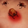 Have you been bitten by a partially fed tick? - Daniel Cameron, MD, MPH