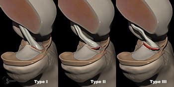 Tibial eminence fractures are not common injuries. Tibial Intercondylar Eminence Fractures - Radsource