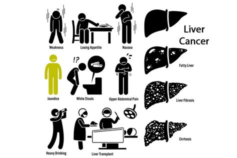 Liver Cancer 101 Symptoms Causes Stages And Treatment Homage