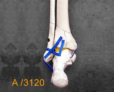 Ankle Large Left Full Length Tibia And Fibula Pilon Fracture A3120
