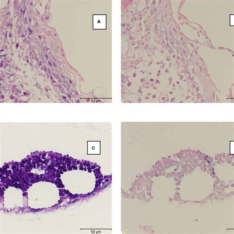 Hpv Associated Koilocytes In Cervical Cin 1 And Putative Koilocytes In