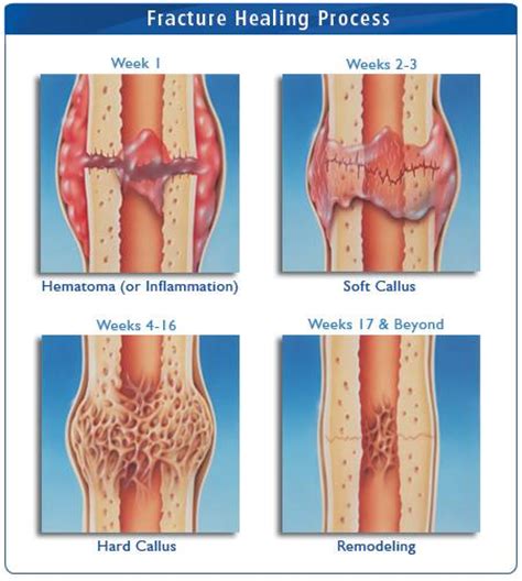 Gap healing occurs in two stages. Flashcards - Ch .52, 53, 54 Musculoskeletal - Pre-Op Care ...