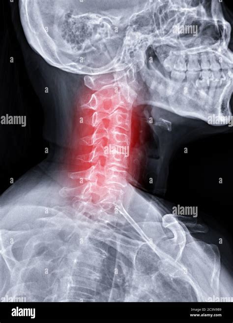 Doctor Patient X Ray Image Cervical Hi Res Stock Photography And Images