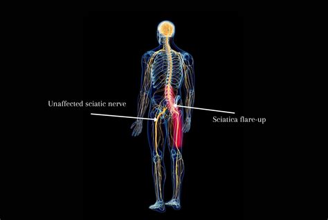 Is Walking Good For Sciatica And If Not What Can Help Instead