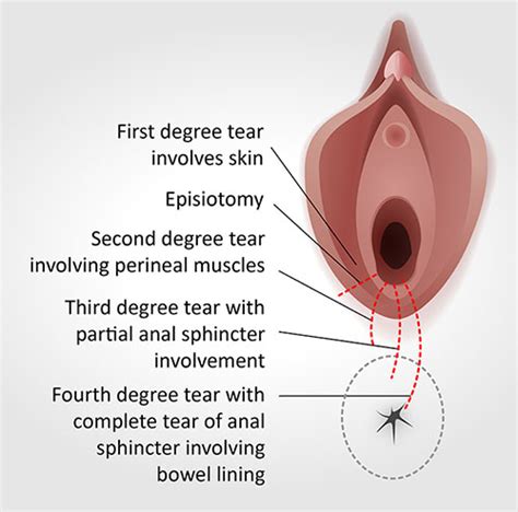 Perineal Tears During Childbirth