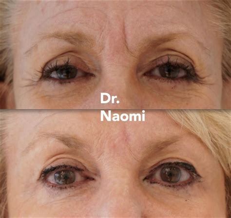 Should you get brow botox? Eyebrow lifting - Best Clinic Sydney for Dermal Fillers