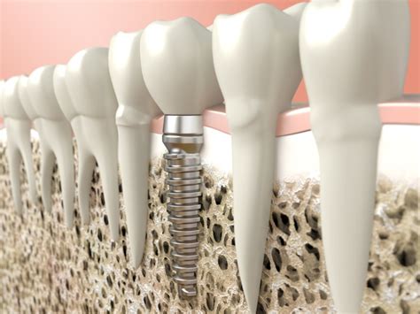 Implantes Orales Profilácticos — Cuaderno De Cultura Científica