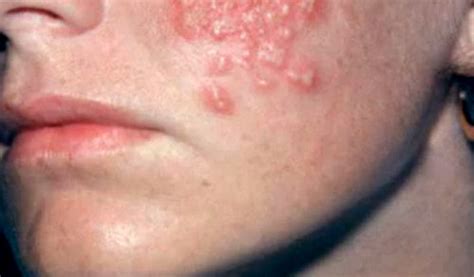 👉 Hiv Rash Pictures What Does Hiv Rash Look Like How Is It