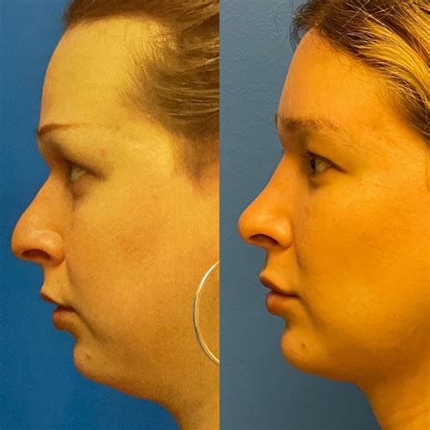 Facial Feminization Before And After Adam Bryce Weinfeld Md Board