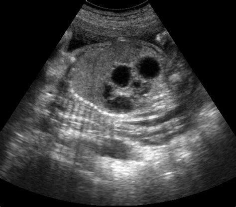 Foetus With Duodenal Atresiaultrasound Bild Kaufen 11565365 Science Photo Library