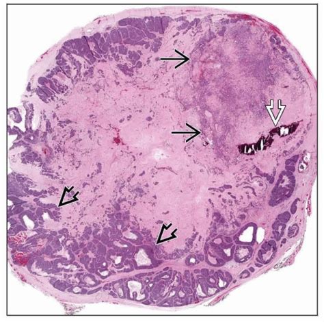 Carcinoma Ex Pleomorphic Adenoma Basicmedical Key