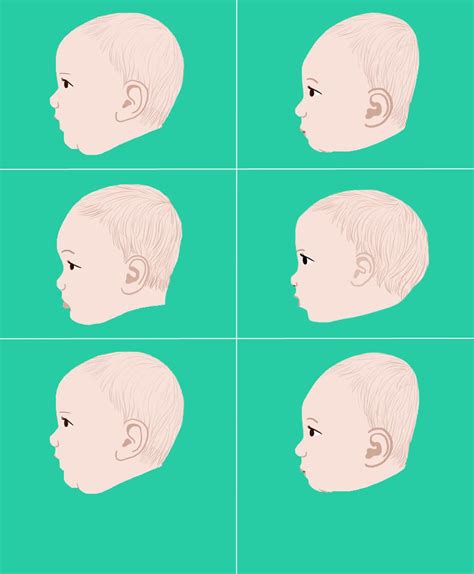 Plagiocephalyflat Head Syndrome Flat Head Syndrome Baby Head Shape