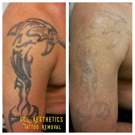 Tattoo Removal Gentle Care Laser Aesthetic