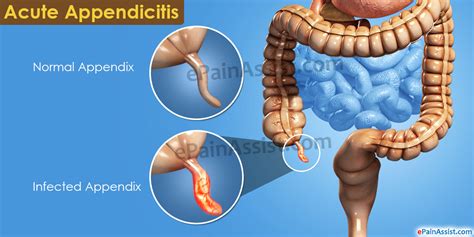 Acute Appendicitiscausessignssymptomstreatment