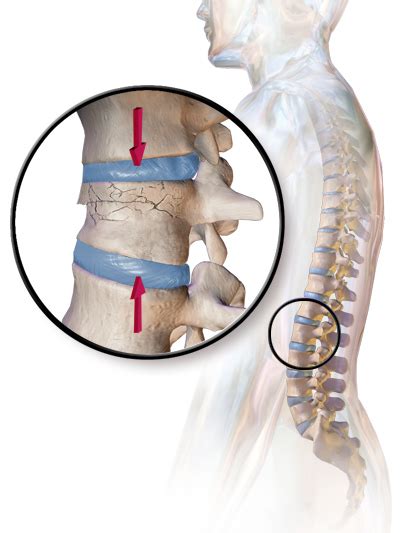 Vertebral Compression Fracture Wikipedia