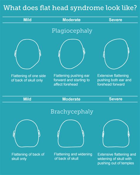 Plagiocephaly And Brachycephaly Flat Head Syndrome Flat Head