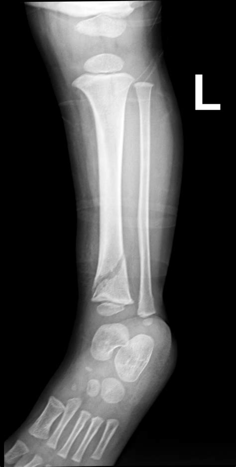 Toddler Fracture Image