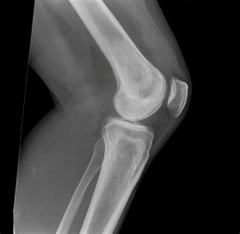 Lateral Radiograph Of Human Knee Joint Monochrome X Ray Picture Or Porn Sex Picture