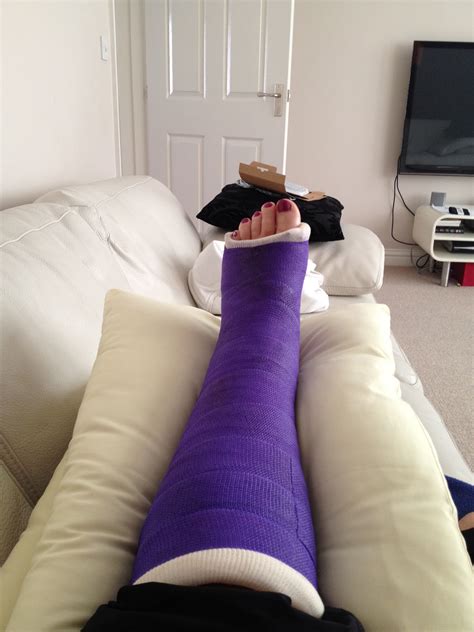 From Cornwall To Crutches Trimalleolar Fracture Purple Casts Are The