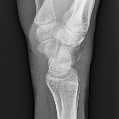 Avulsion Fracture X Ray If People Think That They May Have A Broken