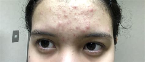 Acne Help Been Dealing With Bumps On My Forehead And Acne For 2 Years