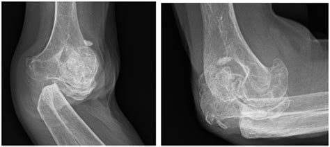 Anteroposterior And Lateral View Of Right Elbow Showing Arthritis With