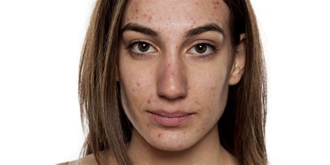 Women Are Now Posting Their Acne Bare Faces Because Its The Latest Beauty Trend Fpn