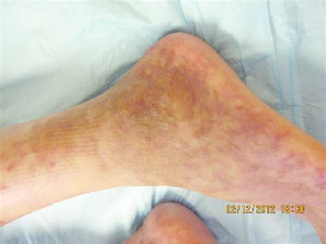 Livedo Reticularis On Initial Presentation Download Scientific Diagram