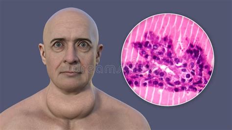 A Man With Enlarged Thyroid Gland 3d Illustration And Micrograph